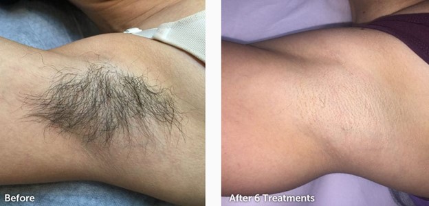 permanant-Hair-Removal